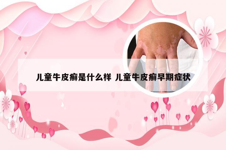 儿童牛皮癣是什么样 儿童牛皮癣早期症状