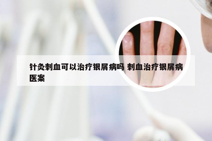 针灸刺血可以治疗银屑病吗 刺血治疗银屑病医案