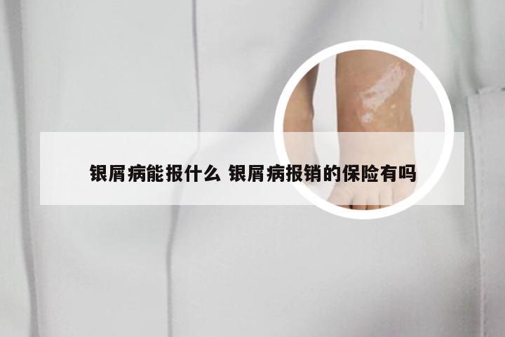 银屑病能报什么 银屑病报销的保险有吗