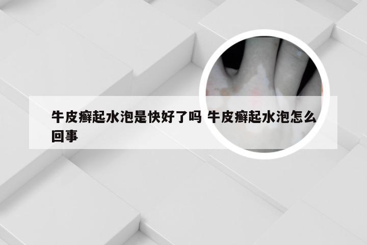 牛皮癣起水泡是快好了吗 牛皮癣起水泡怎么回事