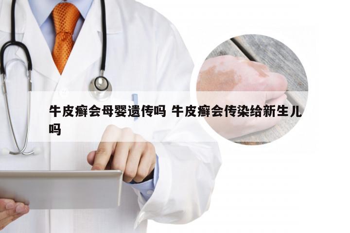 牛皮癣会母婴遗传吗 牛皮癣会传染给新生儿吗