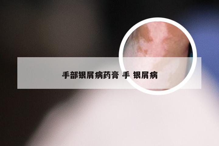 手部银屑病药膏 手 银屑病