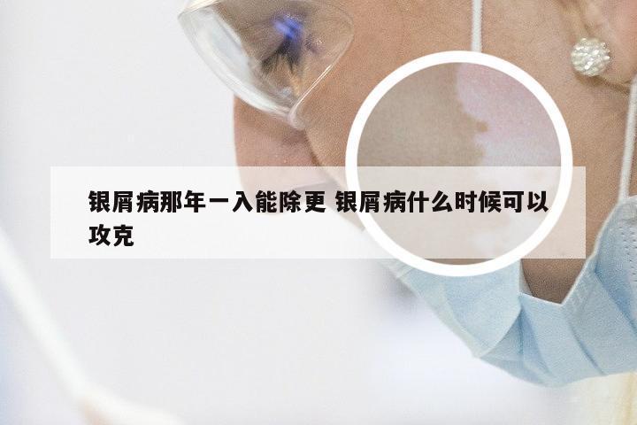 银屑病那年一入能除更 银屑病什么时候可以攻克