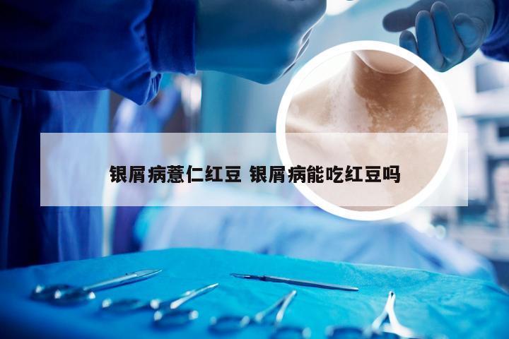 银屑病薏仁红豆 银屑病能吃红豆吗