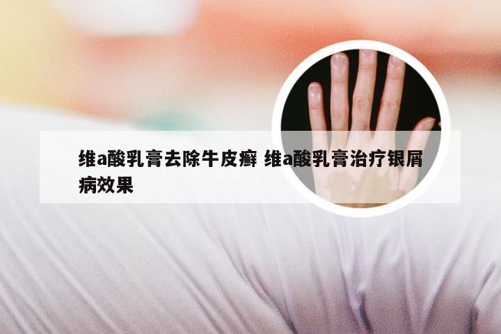 维a酸乳膏去除牛皮癣 维a酸乳膏治疗银屑病效果