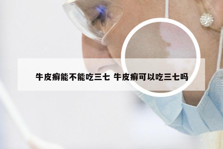 牛皮癣能不能吃三七 牛皮癣可以吃三七吗