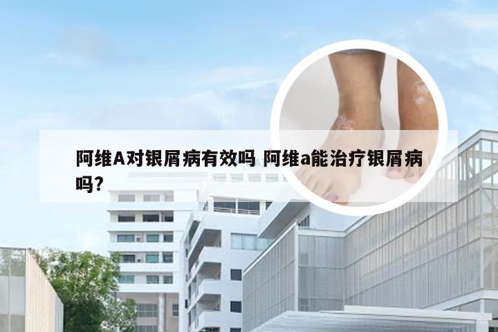 阿维A对银屑病有效吗 阿维a能治疗银屑病吗?