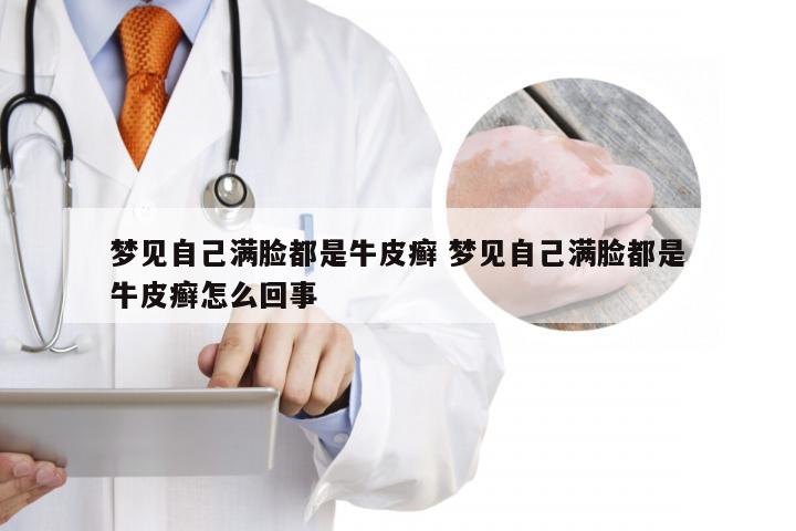 梦见自己满脸都是牛皮癣 梦见自己满脸都是牛皮癣怎么回事
