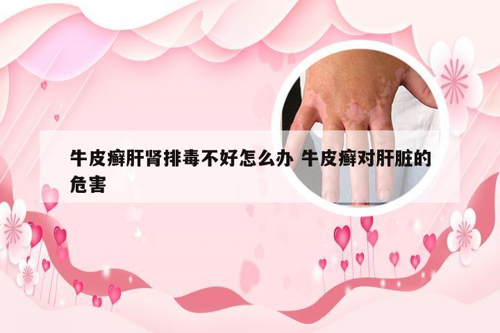 牛皮癣肝肾排毒不好怎么办 牛皮癣对肝脏的危害