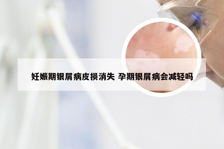 妊娠期银屑病皮损消失 孕期银屑病会减轻吗