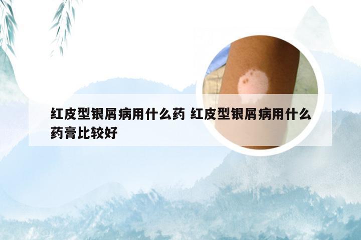 红皮型银屑病用什么药 红皮型银屑病用什么药膏比较好