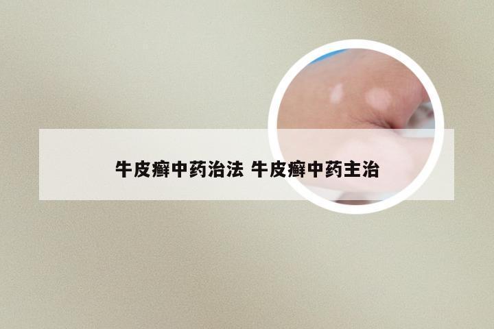 牛皮癣中药治法 牛皮癣中药主治
