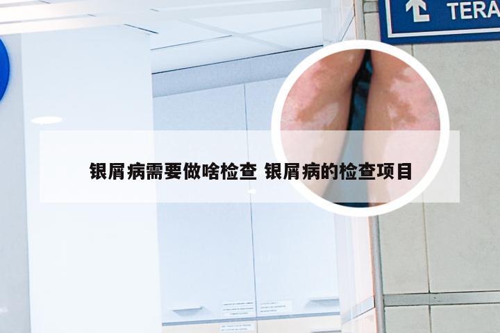 银屑病需要做啥检查 银屑病的检查项目
