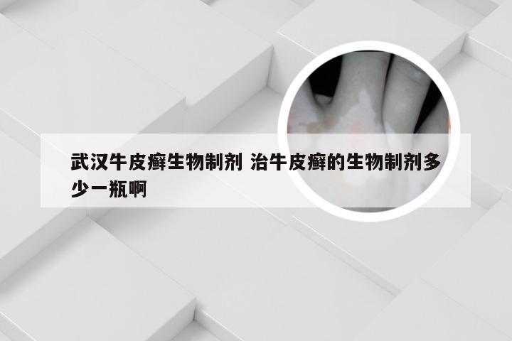 武汉牛皮癣生物制剂 治牛皮癣的生物制剂多少一瓶啊