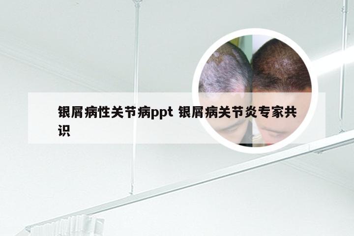 银屑病性关节病ppt 银屑病关节炎专家共识