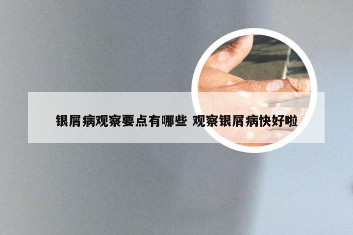 银屑病观察要点有哪些 观察银屑病快好啦