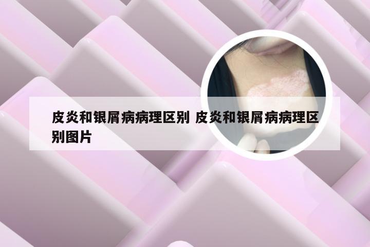 皮炎和银屑病病理区别 皮炎和银屑病病理区别图片