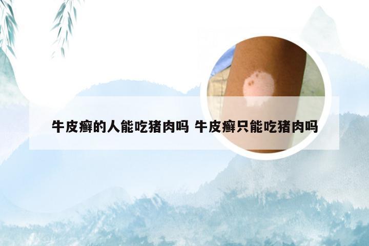 牛皮癣的人能吃猪肉吗 牛皮癣只能吃猪肉吗