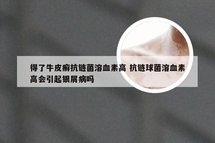 得了牛皮癣抗链菌溶血素高 抗链球菌溶血素高会引起银屑病吗