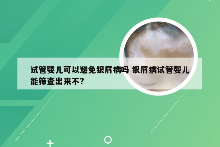 试管婴儿可以避免银屑病吗 银屑病试管婴儿能筛查出来不?