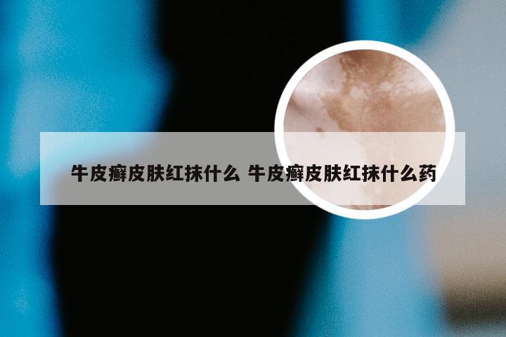 牛皮癣皮肤红抹什么 牛皮癣皮肤红抹什么药