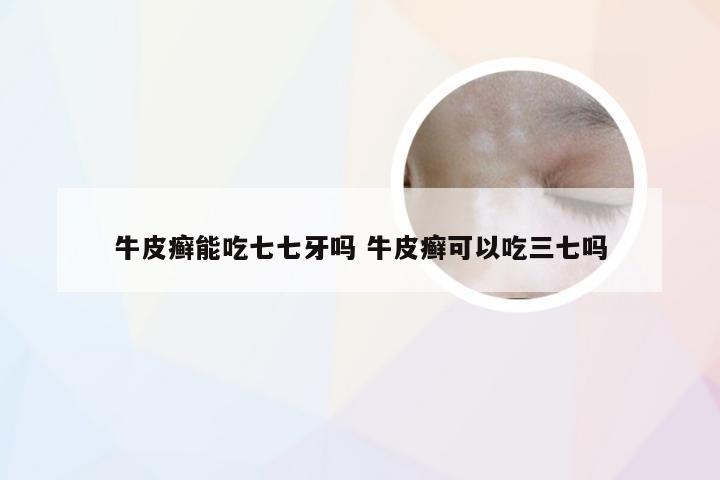牛皮癣能吃七七牙吗 牛皮癣可以吃三七吗