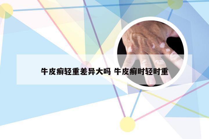牛皮癣轻重差异大吗 牛皮癣时轻时重