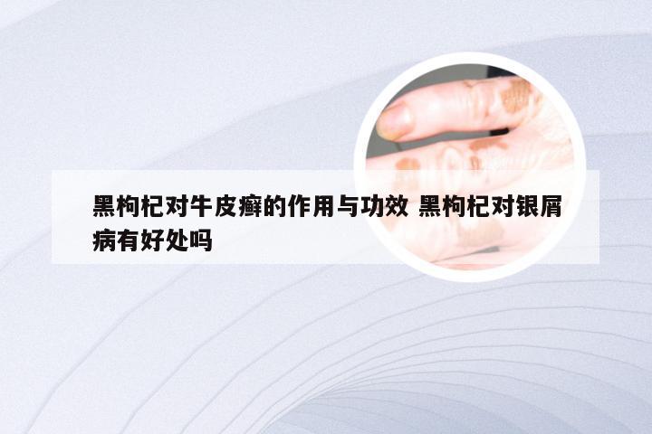 黑枸杞对牛皮癣的作用与功效 黑枸杞对银屑病有好处吗