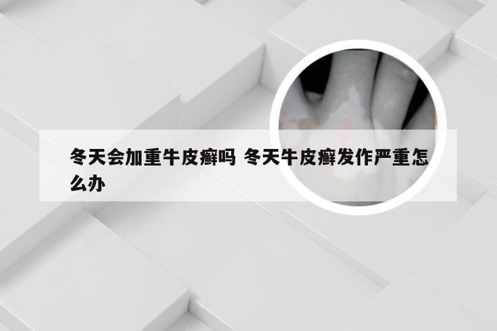冬天会加重牛皮癣吗 冬天牛皮癣发作严重怎么办