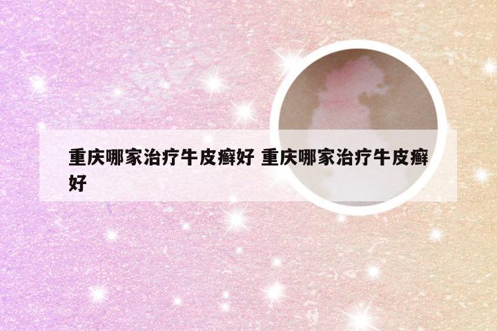 重庆哪家治疗牛皮癣好 重庆哪家治疗牛皮癣好