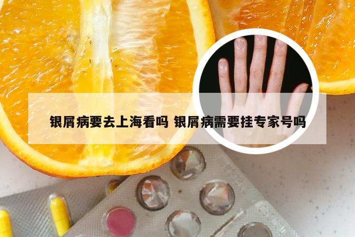 银屑病要去上海看吗 银屑病需要挂专家号吗