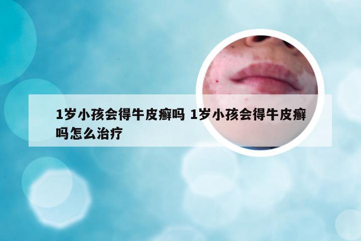 1岁小孩会得牛皮癣吗 1岁小孩会得牛皮癣吗怎么治疗