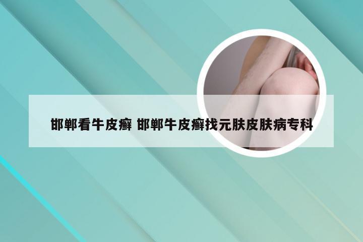 邯郸看牛皮癣 邯郸牛皮癣找元肤皮肤病专科