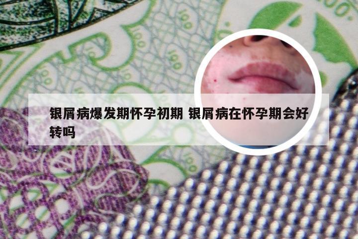 银屑病爆发期怀孕初期 银屑病在怀孕期会好转吗