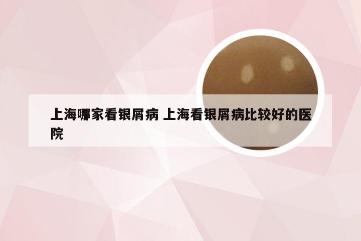 上海哪家看银屑病 上海看银屑病比较好的医院