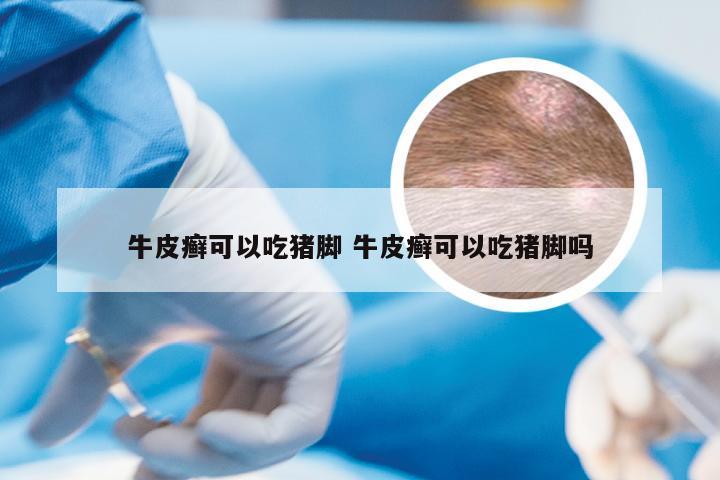 牛皮癣可以吃猪脚 牛皮癣可以吃猪脚吗