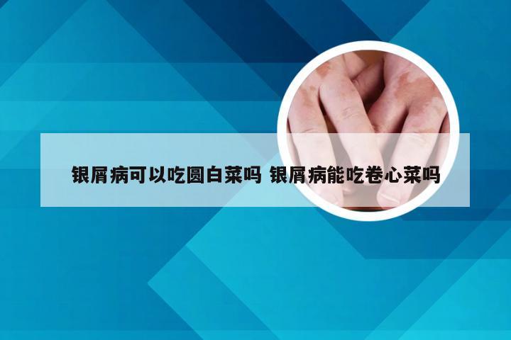 银屑病可以吃圆白菜吗 银屑病能吃卷心菜吗