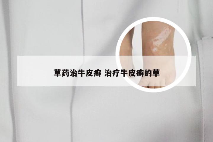 草药治牛皮癣 治疗牛皮癣的草