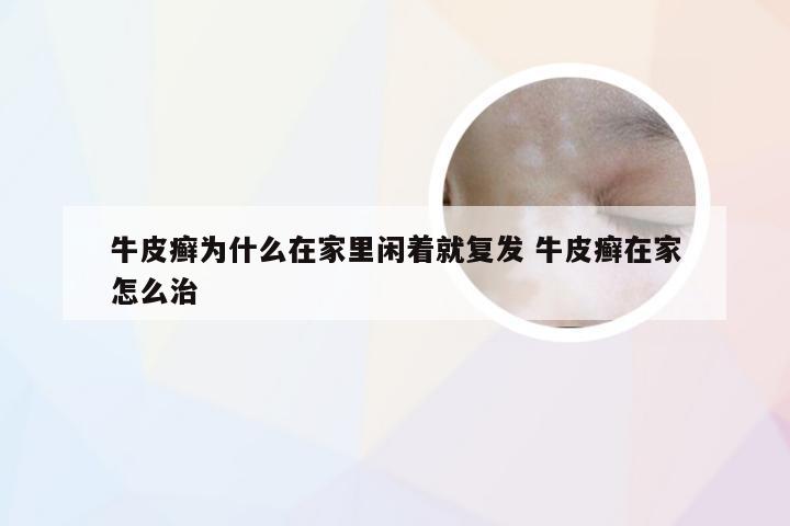 牛皮癣为什么在家里闲着就复发 牛皮癣在家怎么治