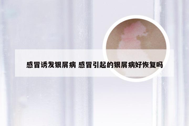 感冒诱发银屑病 感冒引起的银屑病好恢复吗
