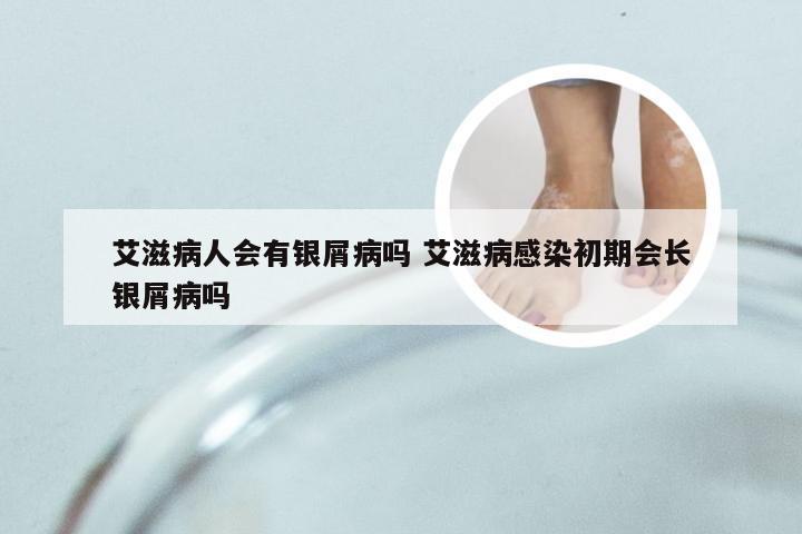 艾滋病人会有银屑病吗 艾滋病感染初期会长银屑病吗