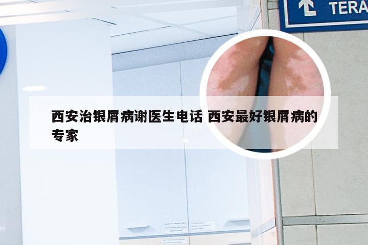 西安治银屑病谢医生电话 西安最好银屑病的专家