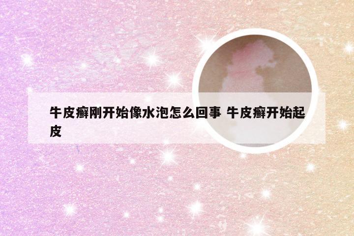 牛皮癣刚开始像水泡怎么回事 牛皮癣开始起皮