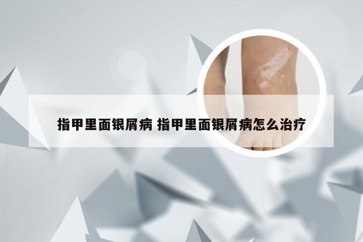 指甲里面银屑病 指甲里面银屑病怎么治疗