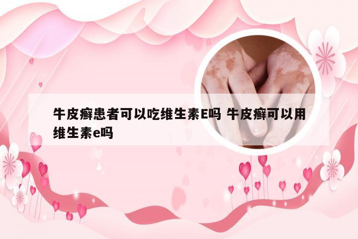 牛皮癣患者可以吃维生素E吗 牛皮癣可以用维生素e吗