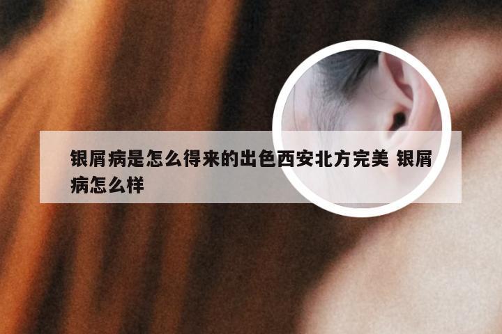 银屑病是怎么得来的出色西安北方完美 银屑病怎么样