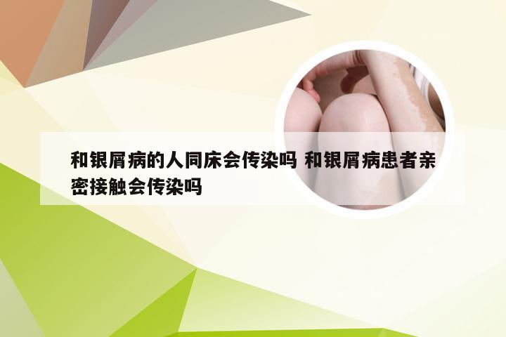 和银屑病的人同床会传染吗 和银屑病患者亲密接触会传染吗