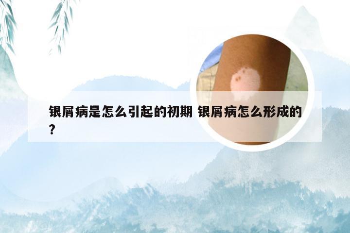 银屑病是怎么引起的初期 银屑病怎么形成的?