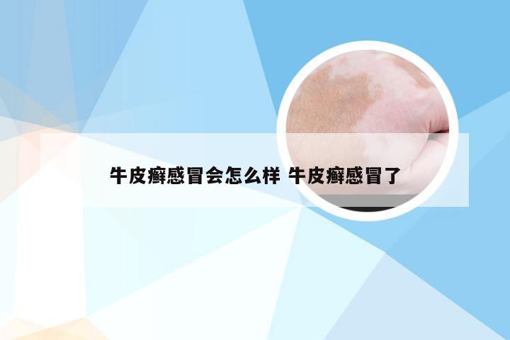 牛皮癣感冒会怎么样 牛皮癣感冒了