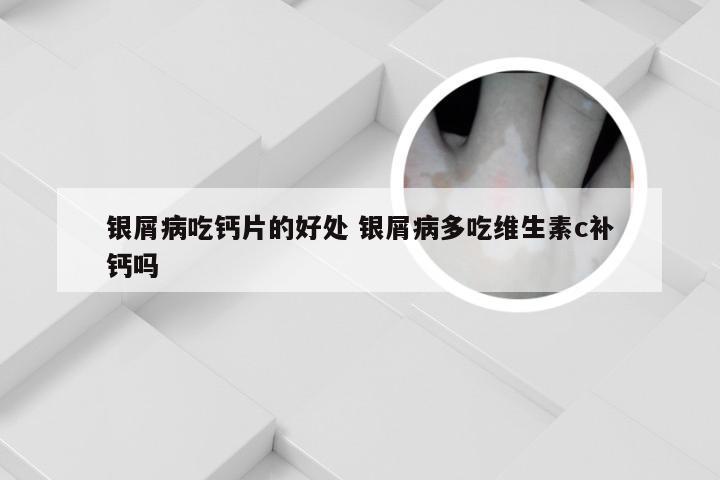 银屑病吃钙片的好处 银屑病多吃维生素c补钙吗